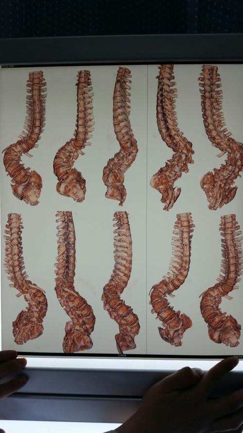 3d打印技术在重度脊柱畸形合并完全截瘫患者手术中的应用(延安市人民