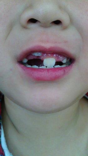 小孩7岁乳牙己经掉了,门牙上方牙龈处长了一颗牙齿,这是什么牙,恒牙吗