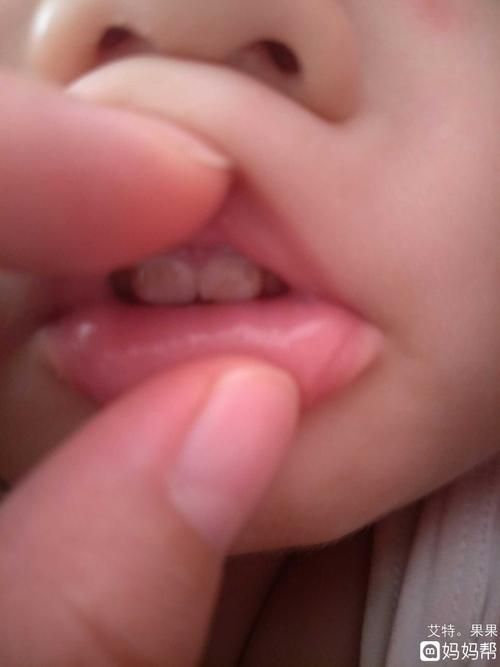 宝宝牙齿钙化早期图片怎么办