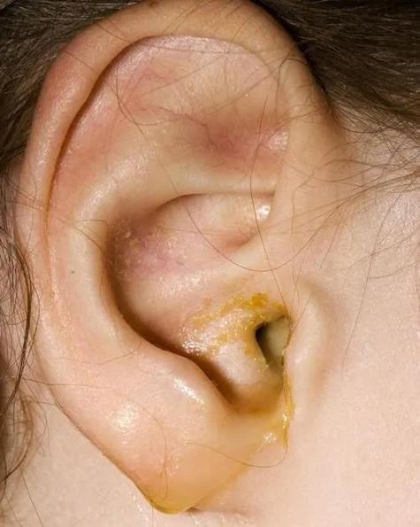 耳朵经常性流水是怎么回事