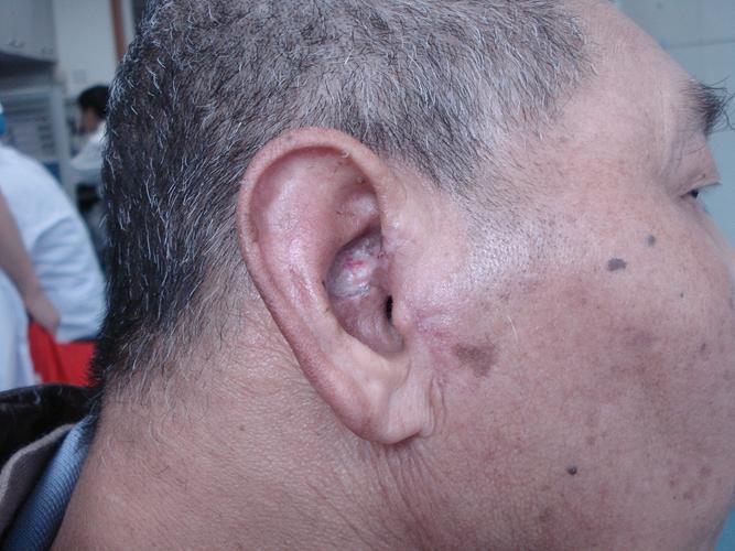 耳廓肿瘤(耳甲艇基底细胞乳突状瘤)