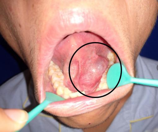 囊肿位于口底一侧黏膜下,呈淡蓝色肿物,囊壁薄,质地柔软,较大可波及更