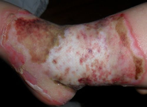 问题:右脚三度烫伤,如果不植皮,自己康复要多久,会留疤影响功能吗?