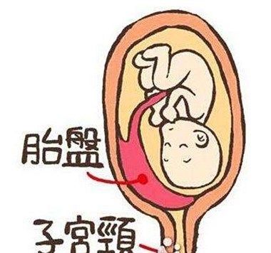 胎盘位于子宫后壁是不是不好顺产