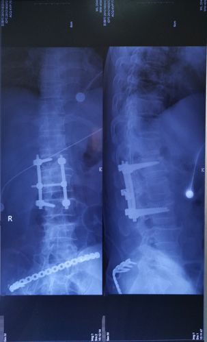 54岁腰椎压缩性骨折切开复位椎弓根内固定手术一例