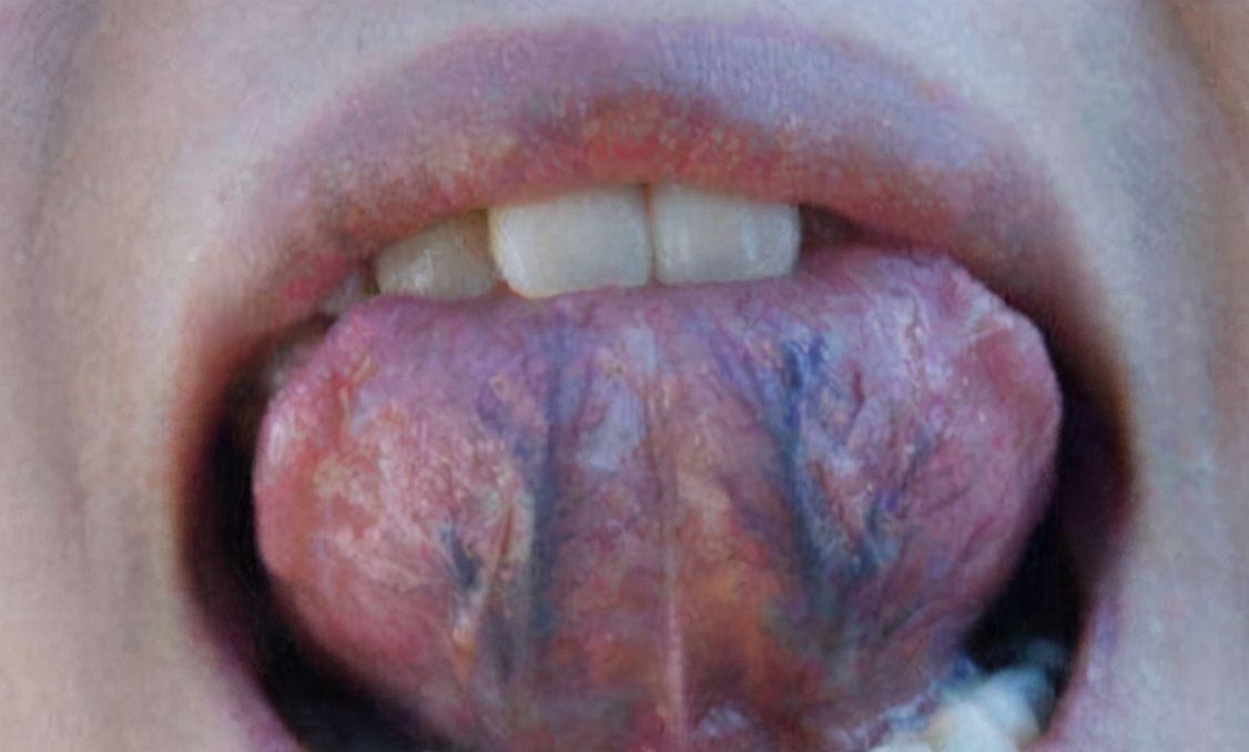 舌头发紫发黑怎么回事