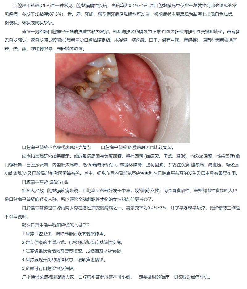 广州穗雅医院口腔黏膜科讲述究竟什么是口腔扁平苔藓