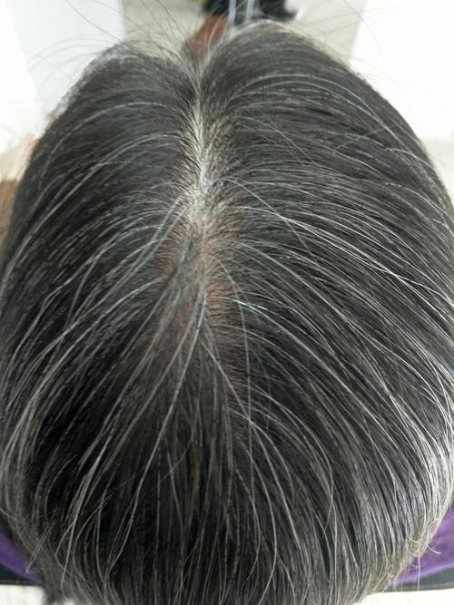 法尔加治疗白发转黑发成功案例.