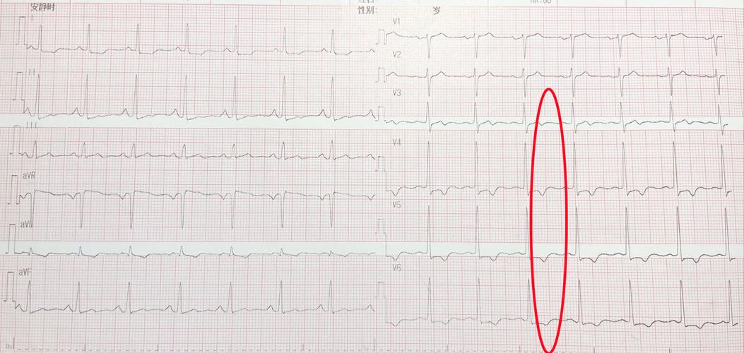 心电图t波改变是怎么回事儿?就是冠心病吗?