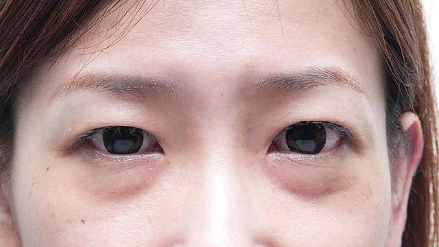 眼袋的形成与眼眶中脂肪积累过多,眼睑支撑结构变弱有关,随着年龄的