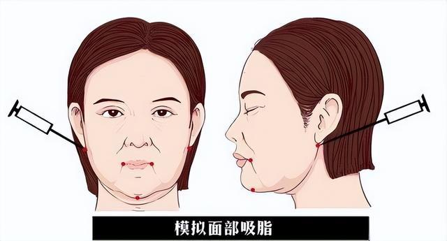 面部吸脂手术之前要了解原理和特点,许多人一直没搞懂,吃过很多亏