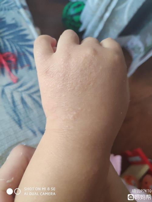 宝宝手上起湿疹有什么好方法求