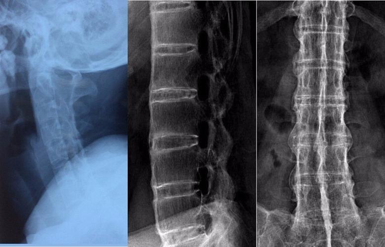 强直性脊柱炎诊断与规范化治疗 - 好大夫在线