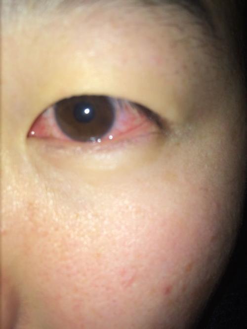 眼睛里全是红血丝,但是眼睛没有不舒服,这是怎么了?眼睛会不会瞎啊