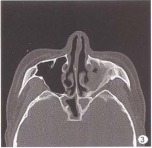 颅底ct 示:左侧上颌窦,筛窦,双侧蝶窦黏膜增厚( 图3).