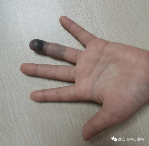 西安市中心医院五岁女童手指夹伤竟然险些被截指