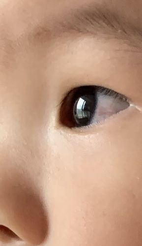 问:八个月婴儿左眼外侧白眼球有较明显红血丝,有少量眼屎,应如何处理?