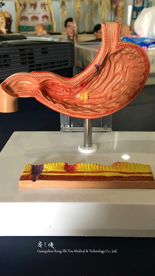 r100208 胃解剖模型胃溃疡食管模型
