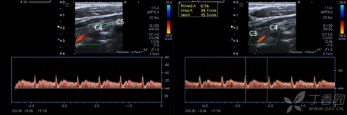 左侧椎动脉(c3-4)频谱改变.