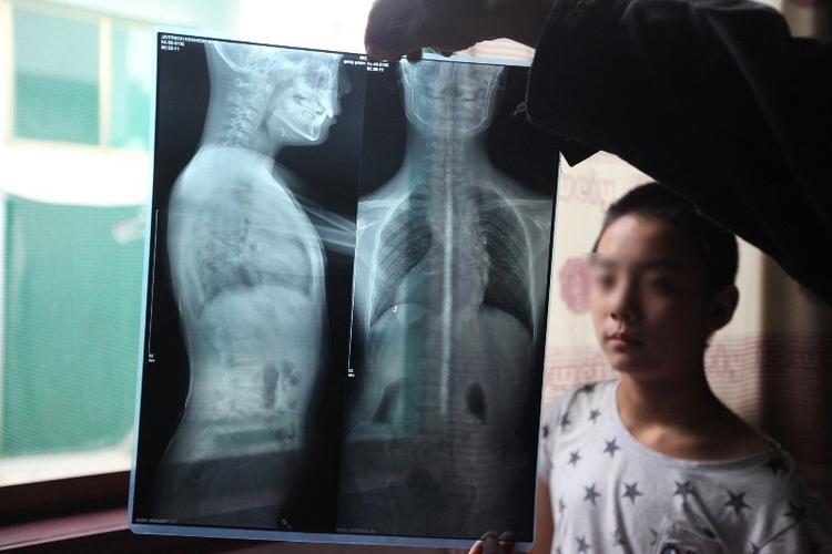 12岁男孩患脊椎侧弯:不怕手术 就担心钱凑不够