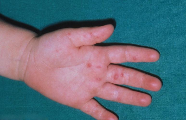 手足口病高发如何做好预防工作娃有这几种症状要立即就医