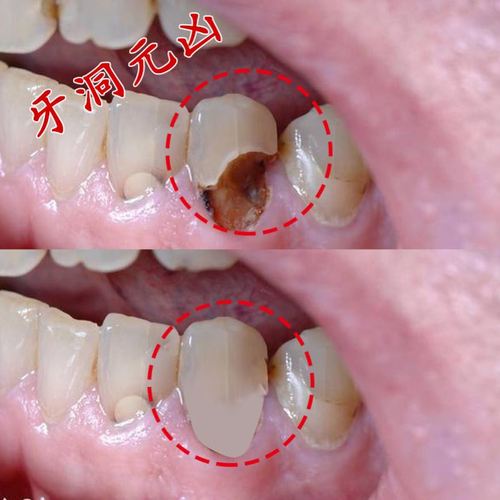 【小红书推荐】告别蛀牙虫洞 牙齿黑窟窿 蛀牙修复牙洞自己补坏牙