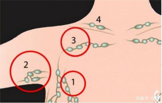 临床上腋窝淋巴结肿大的常见原因有四种,其一是腋窝淋巴