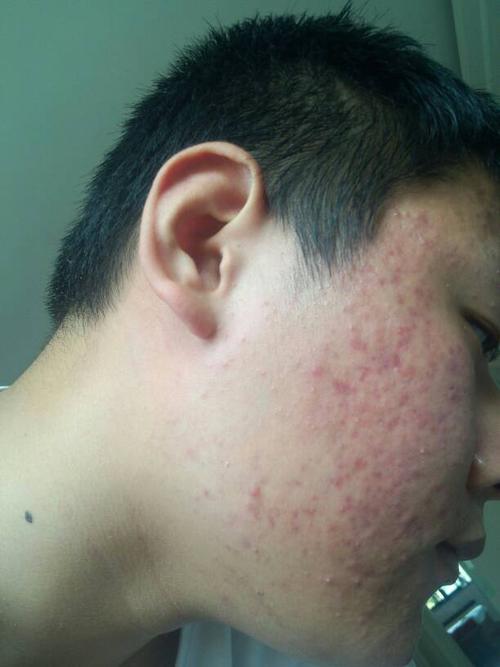 2013-12-02 李海玲 医师 脸上痘痘又红又紫,还挺大,下巴一圈都是,以前