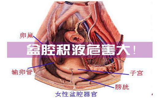 详细来说,b超检查所说的盆腔积液其实就是子宫直肠陷窝(也称后陷凹)有