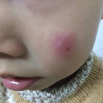 我家宝宝一岁四个月了,前段时间挨蚊子咬脸上长了包包,都一个月了怎么