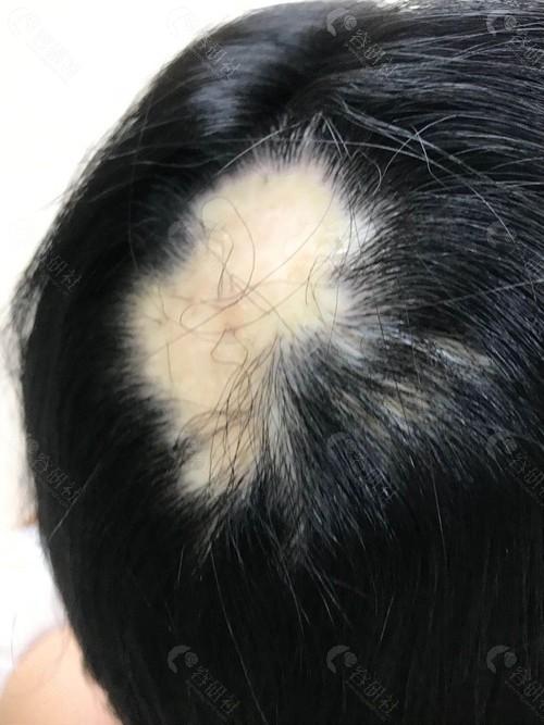 一块小疤痕植发大概多少钱疤痕植发后成活率很低吗