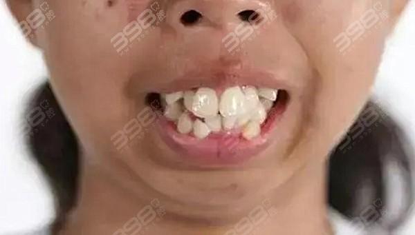 轻微凸嘴和严重对比图片从凸嘴各种程度照片看如何改善龅牙问题