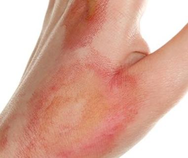 1,用凉水冲洗伤口:一旦出现烫伤,感觉皮肤有发红,发热,疼痛的症状时