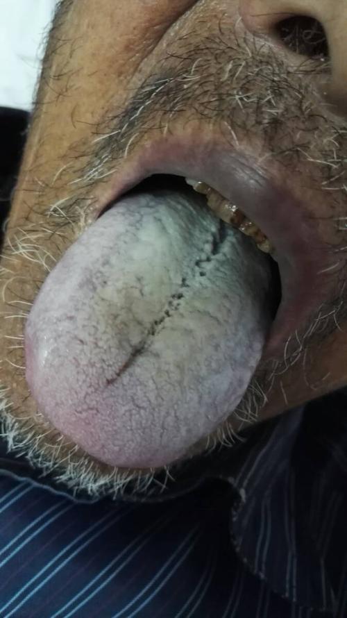 二床胃癌患者治疗前舌象,口唇,面色