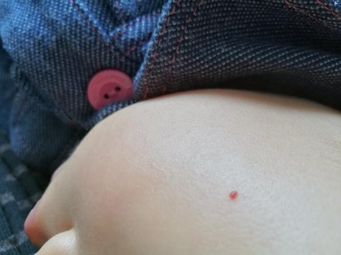 小孩脸上突出的红血点