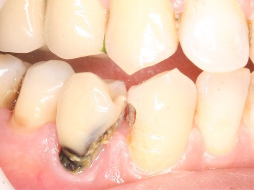 右侧后牙牙颈部龋坏多年,今行间接盖髓术 光固化树脂充填术修复