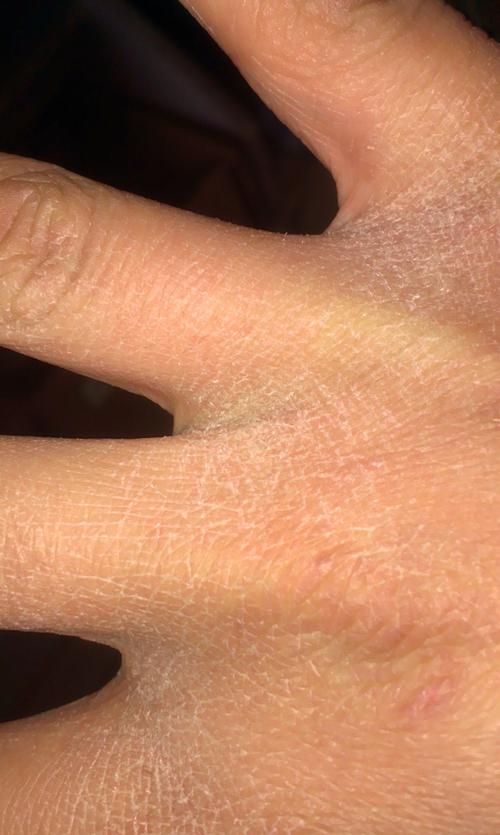 现在都是春天接近夏天了,可是我的手指缝间有一层皮脱落,看起来很干燥