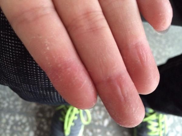 手指皮肤角化症怎么治疗