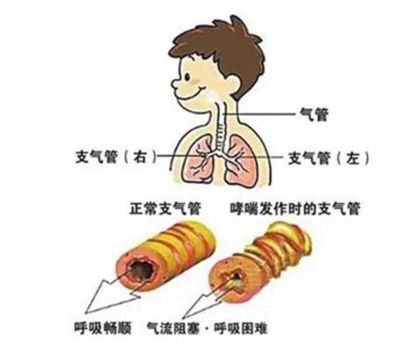 哮喘的症状