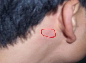 耳后淋巴癌早期症状图 耳朵下面痛是什么原因