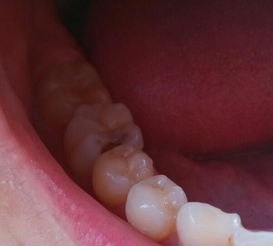 牙齿有个洞,这边牙一吃东西就痛,这是什么牙病,怎样才能治好?