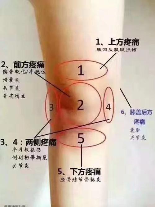 膝盖疼的几种原因