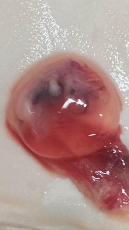 看到外形的宫外孕胚胎