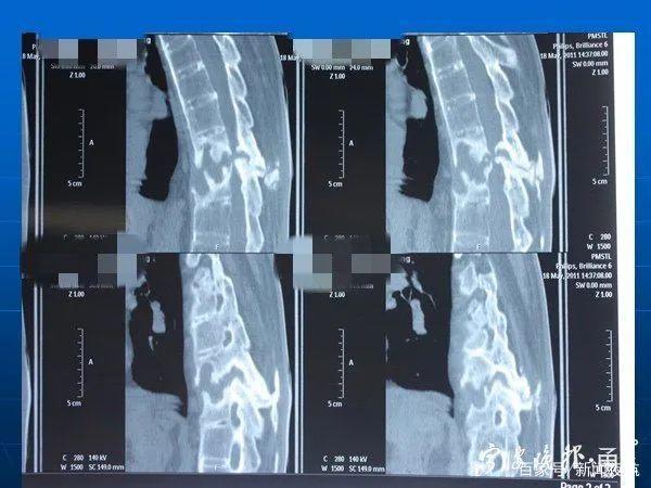 经过全面的检查发现,刘强患有强直性脊柱炎,且已是晚期, 整个脊柱都有