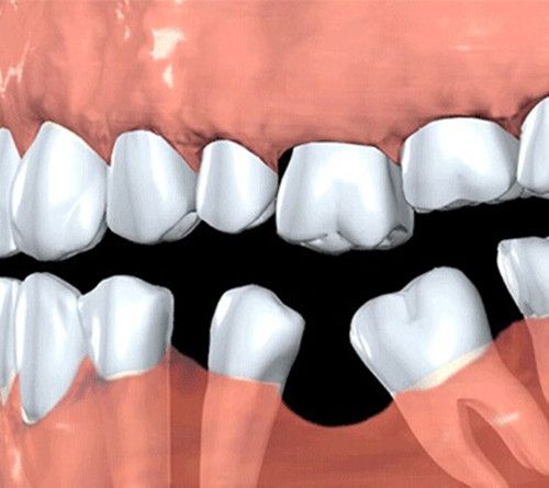 推荐阅读>>>根管治疗后牙齿使用寿命有多长