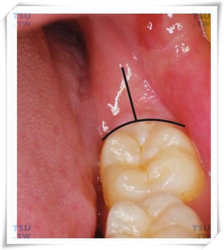 智齿拔除术切口的类型