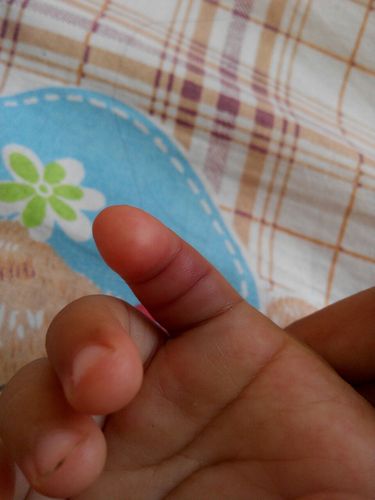手指化脓发肿图片