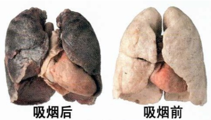 吸烟——肺癌的重要因素