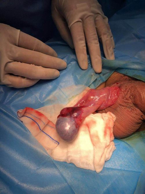 扭转复位后的睾丸,缺血征象明显好转.