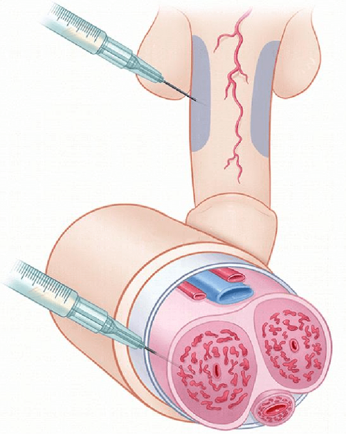 龙根生—海绵体活化技术是通过体外培养具有血管再生,修复活性的修复